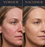 Jünger, Frischer-LUMÉRA GlowMask PRO